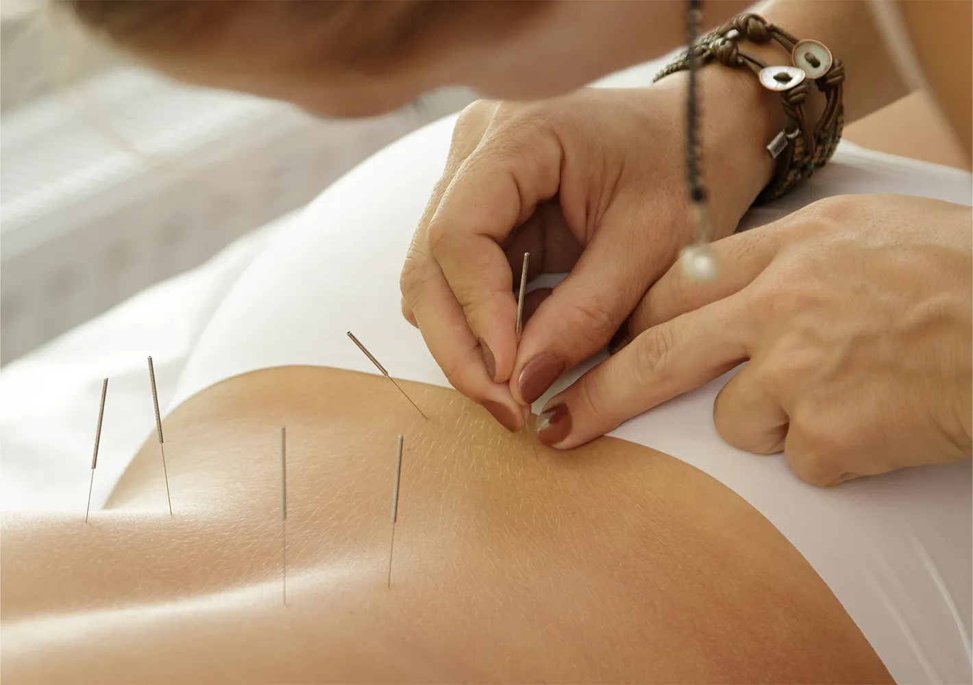akupunktur